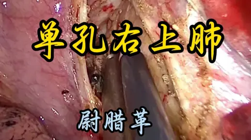 单孔胸腔镜右肺上叶癌根治术原速未剪辑 解说版 尉腊革教授供稿