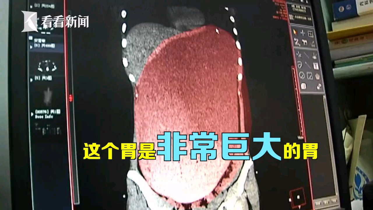 女子一顿饭吃太多险被撑死10个包子4个鸡腿30个雪糕3000毫升奶茶