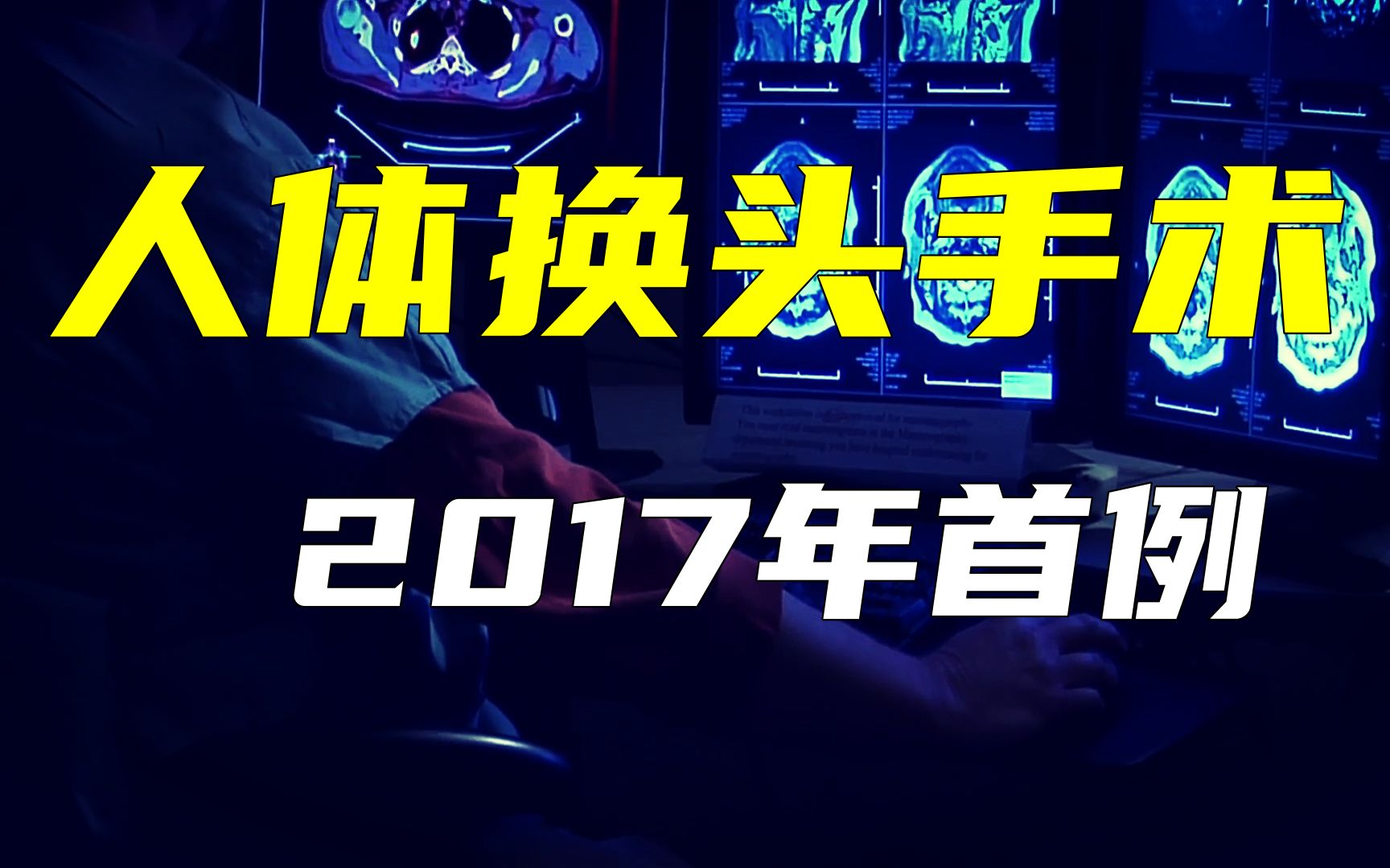 [图]换头手术可行吗？2017年，科学家准备的人类首例换头手术怎样了？