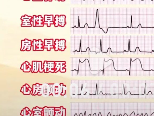 室性早搏心电图特点图片