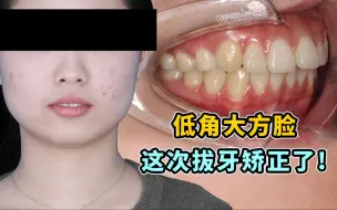 Download Video: 【低角大方脸女生】这次拔牙了？ 脸会变得更方吗？