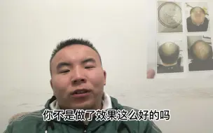 Скачать видео: 植发173天，大家千万不要植发全是骗人的，真心希望我的植发经历，对你有帮助