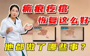 Download Video: 他的瘢痕疙瘩恢复的这么好，他都做了哪些事呢？有瘢痕疙瘩的值得看！