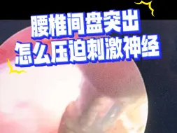 Download Video: 腰椎间盘突出是怎么压迫刺激神经的？