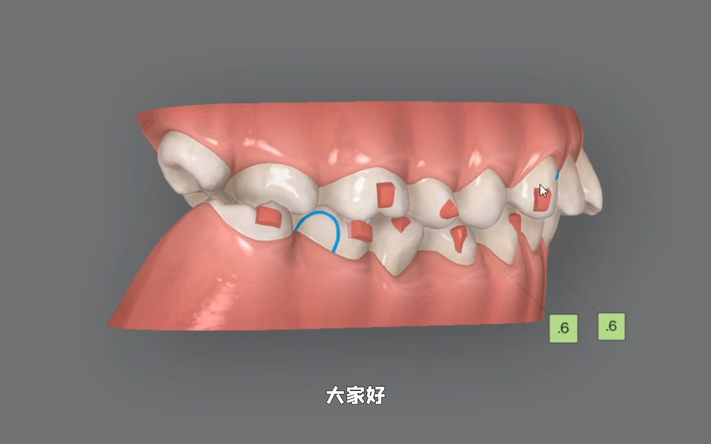 上颌骨性嘴突、下牙部分牙齿缺失,通过牙齿矫正和种植牙成功改善的案例哔哩哔哩bilibili