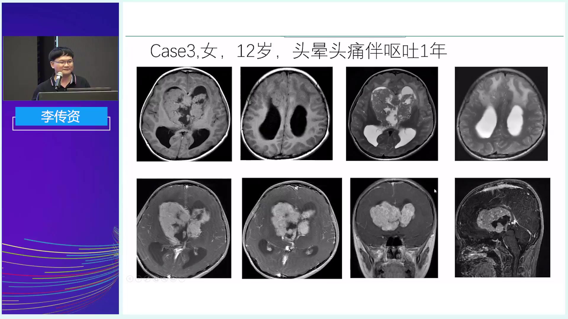 [图]中枢神经细胞瘤的MRI诊断与鉴别诊断