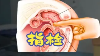 前列腺指检 | 你需要知道的