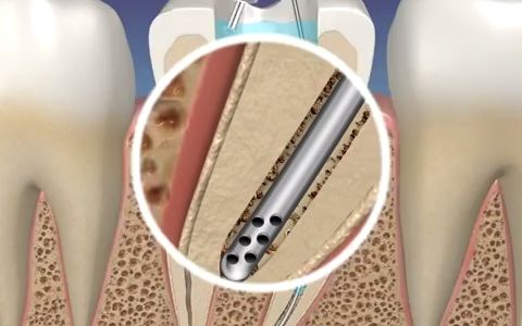 [图]【牙体牙髓】EndoVac负压冲洗系统的动画演示介绍（自制英文字幕）