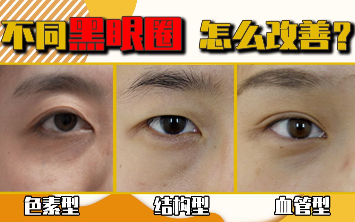 如何正确改善不同类型黑眼圈?