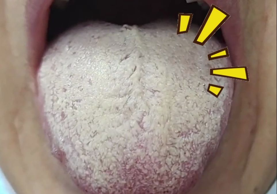 舌象分享:如此厚腻的舌苔,看着让人想吐!