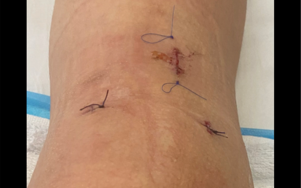 前叉断裂acl重建 前交叉韧带重建!医生说我手术非常顺利!