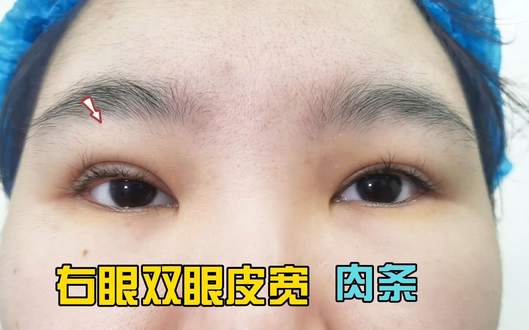 右眼双眼皮宽 有肉条感 双眼不对称