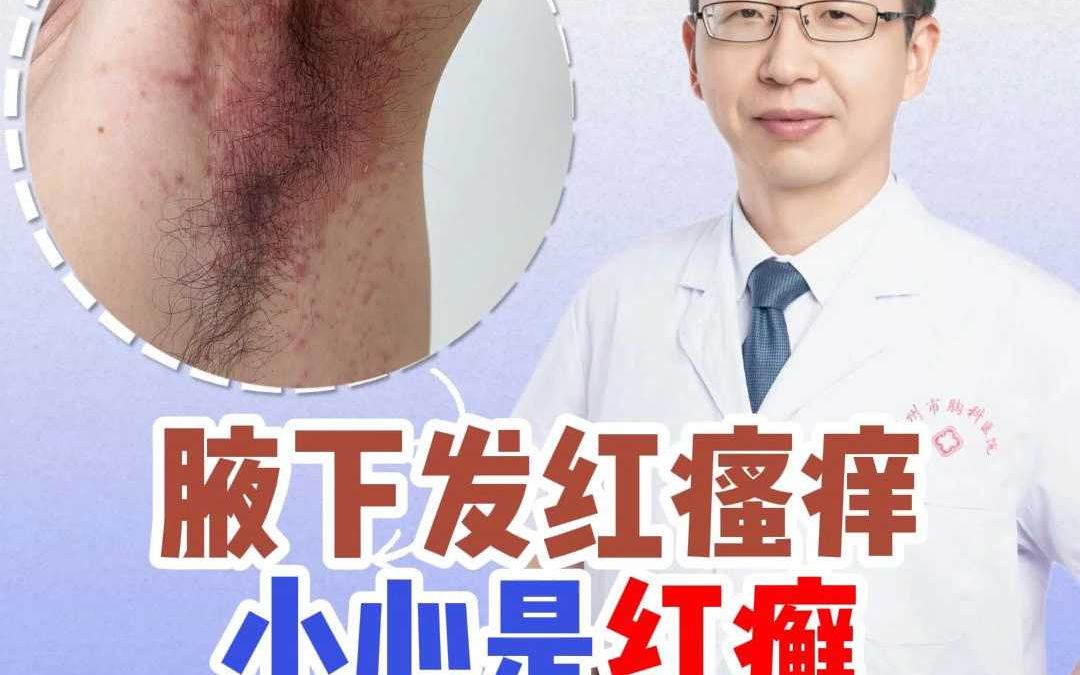 腋下发红瘙痒小心是红癣哔哩哔哩bilibili