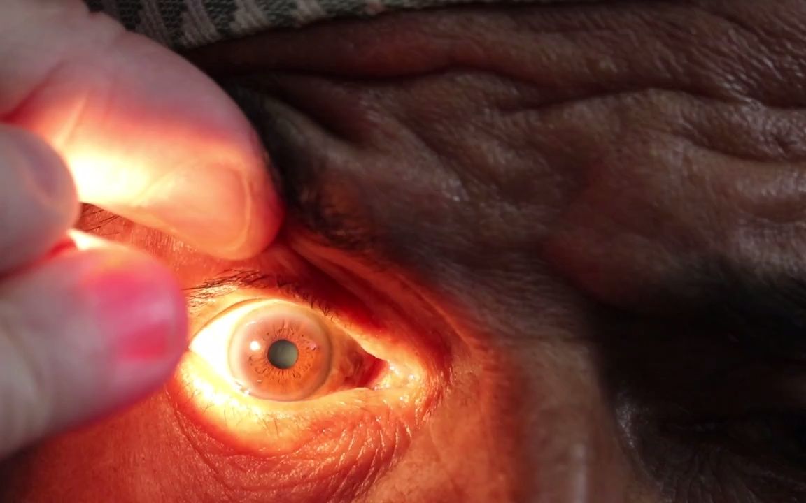 【白内障虹膜投影检查】iris shadow in cataract哔哩哔哩bilibili