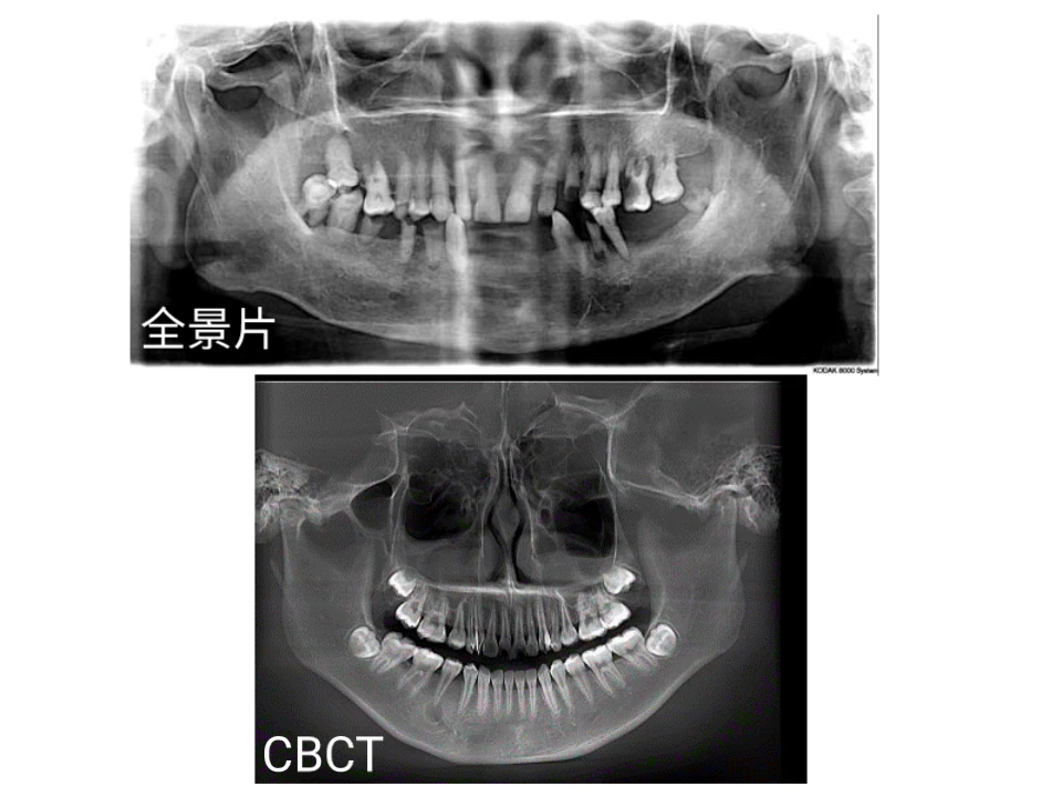 口腔ct: 全景片与cbct,cbct的图像的边缘明显比全景片的图像的边缘更
