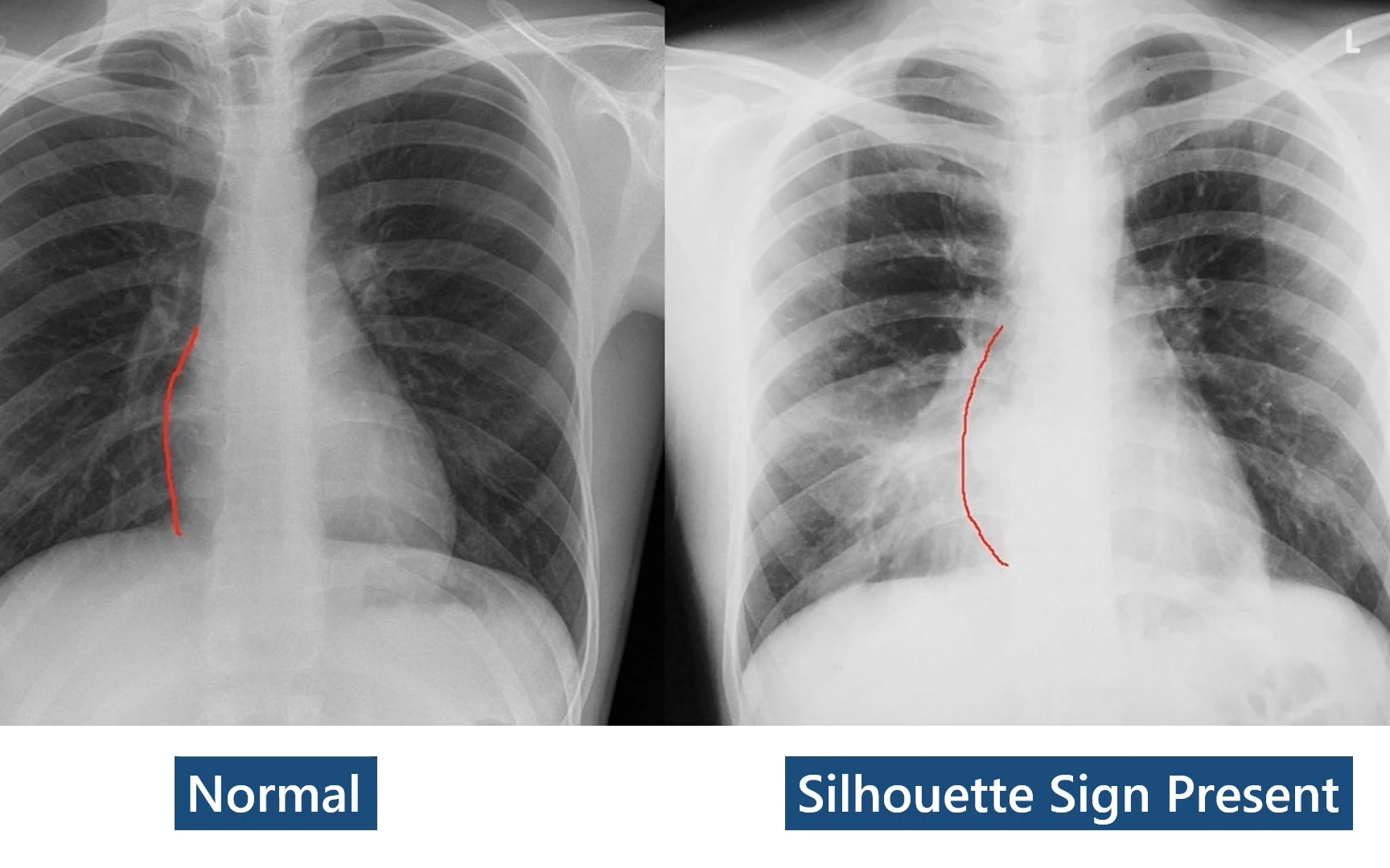 [图]Signs in Chest X-ray(1080P_HD)