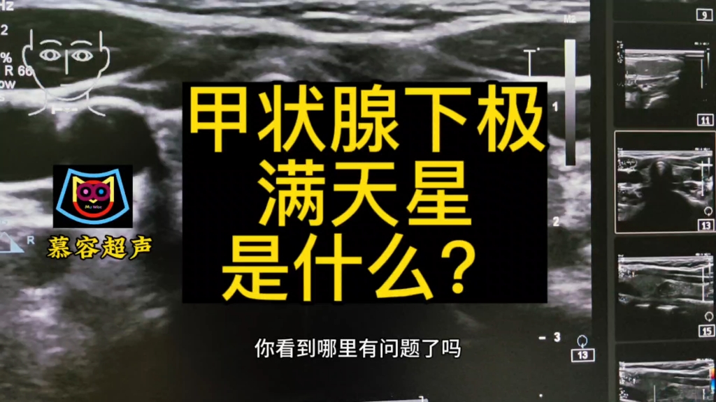 甲状腺下极满天星很多亮点的结节是什么?想学习的来我病例课里学习.哔哩哔哩bilibili