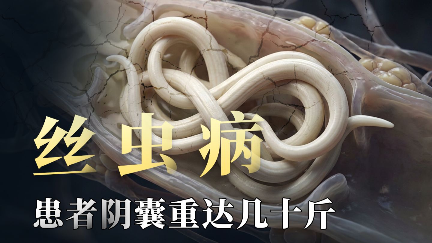 一条寄生虫引起的象皮病，中国又是怎么将其扼杀的？