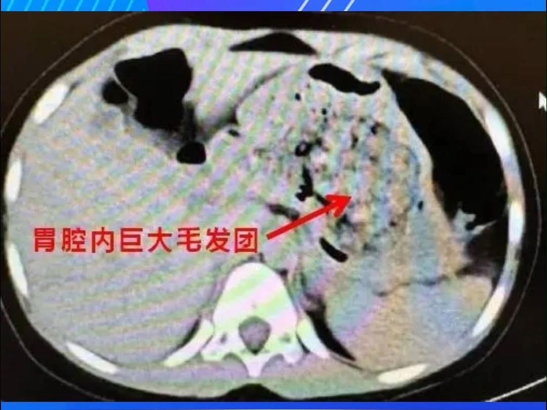 浙江一5岁女孩确诊“长发公主综合征” 全国多地已有病例#罕见病 #公主病 #熊孩子哔哩哔哩bilibili