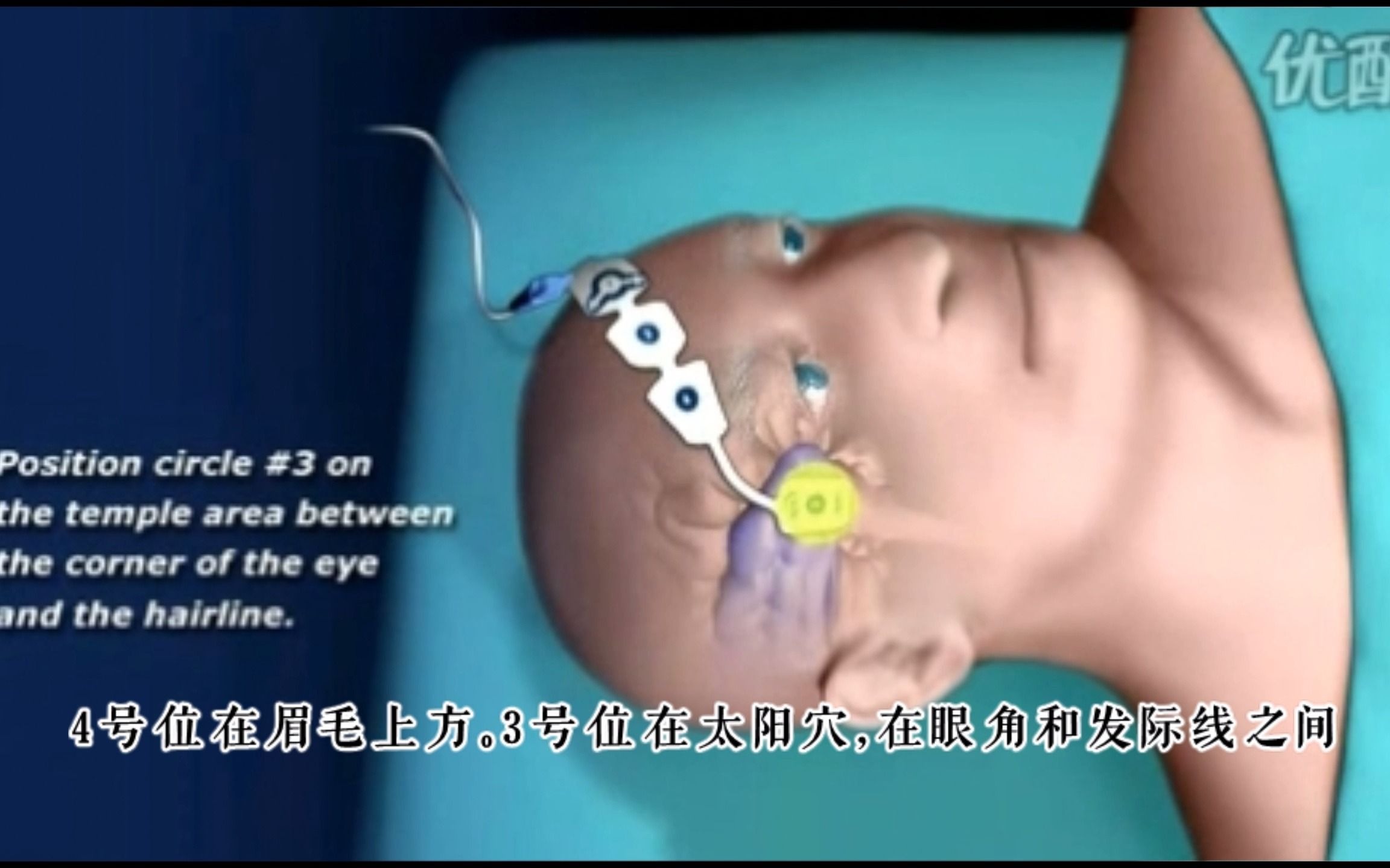 【中文字幕】原来麻醉医生靠这个一眼看出麻醉深度之BIS监测仪器动画哔哩哔哩bilibili