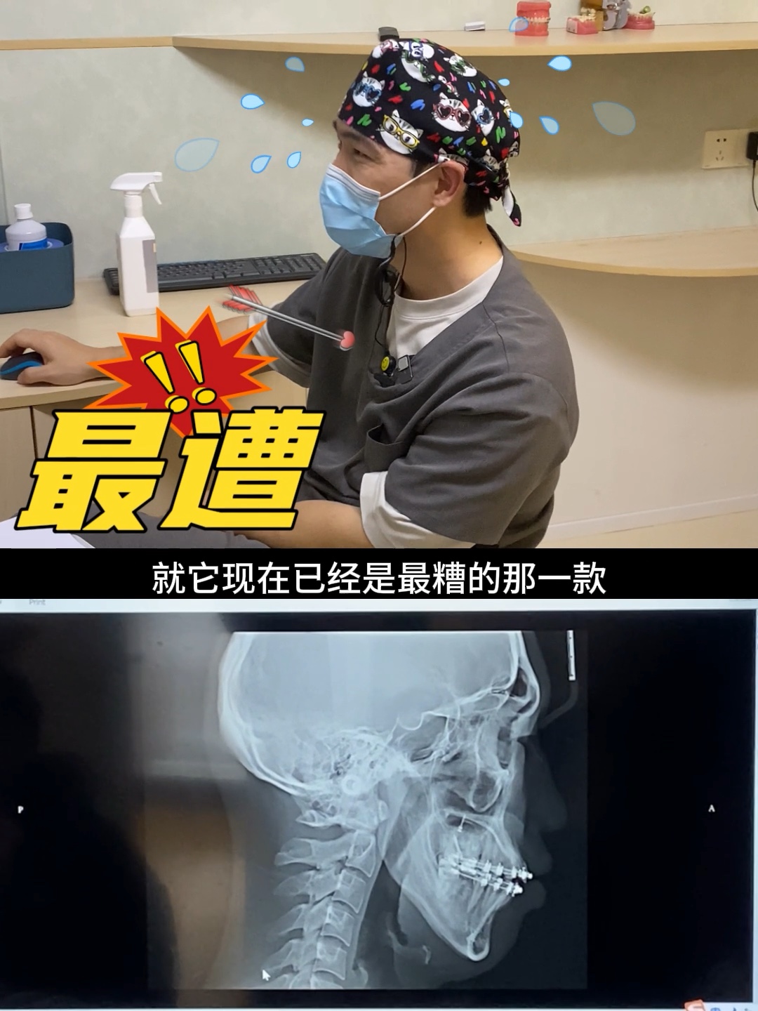 天生骨开窗骨开裂是种什么体验?!口内戴着托槽来的初诊男生,主诉在做完颞下颌关节手术后,牙齿呈现开颌状态,但由于牙槽骨薄,所以原先方案没拔...