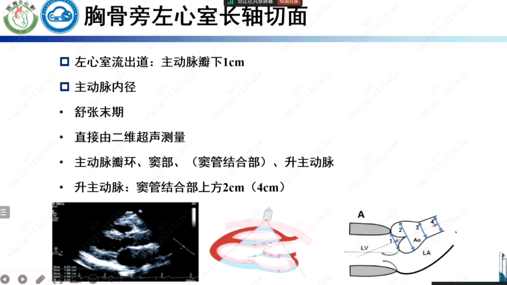 如何看懂心脏彩超图图片