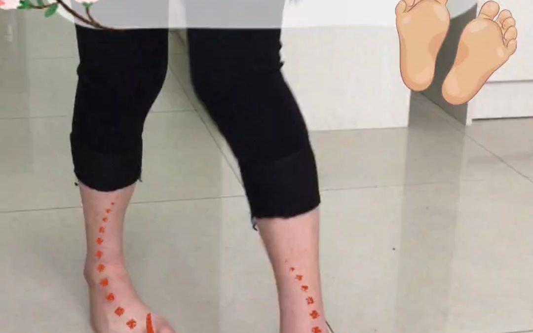 胡霞医生不开刀无创极速矫正高弓足马蹄内翻足 拯救一双美丽的脚