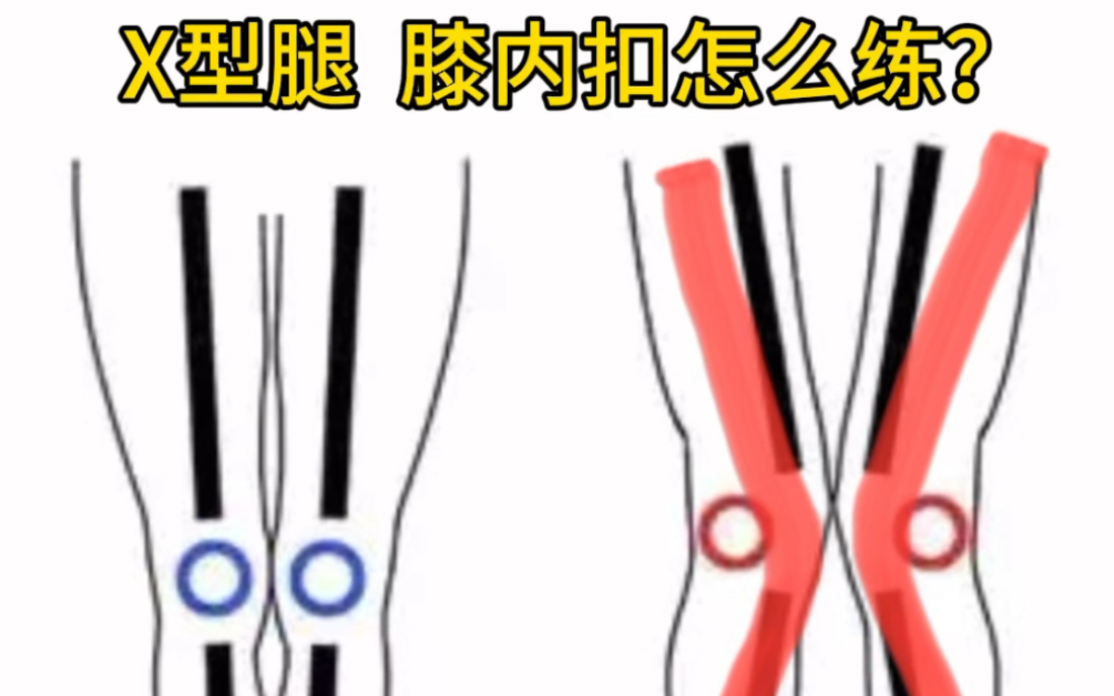 x型腿,膝盖内扣怎么练?