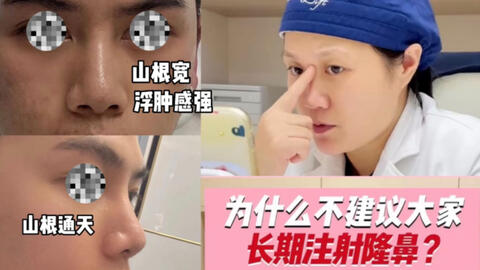 隆鼻 不要打玻尿酸注射山根 扒皮价格虚高与后遗症 医院强制消费真假混打 两次经验分享 哔哩哔哩