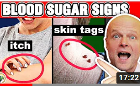 血糖高的10个信号 **10 Alarming Signs Your Blood Sugar Is Too High哔哩哔哩bilibili