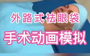 Download Video: 30秒带你了解眼袋如何去除之外切法。