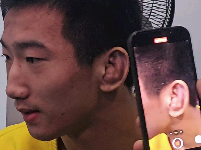 这叫饺子耳，在街头千万不能惹！