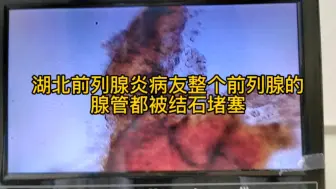 Video herunterladen: 湖北前列腺炎病友整个腺管都被结石堵塞