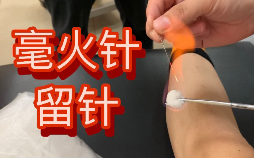 针灸手法演示/毫火针的留针