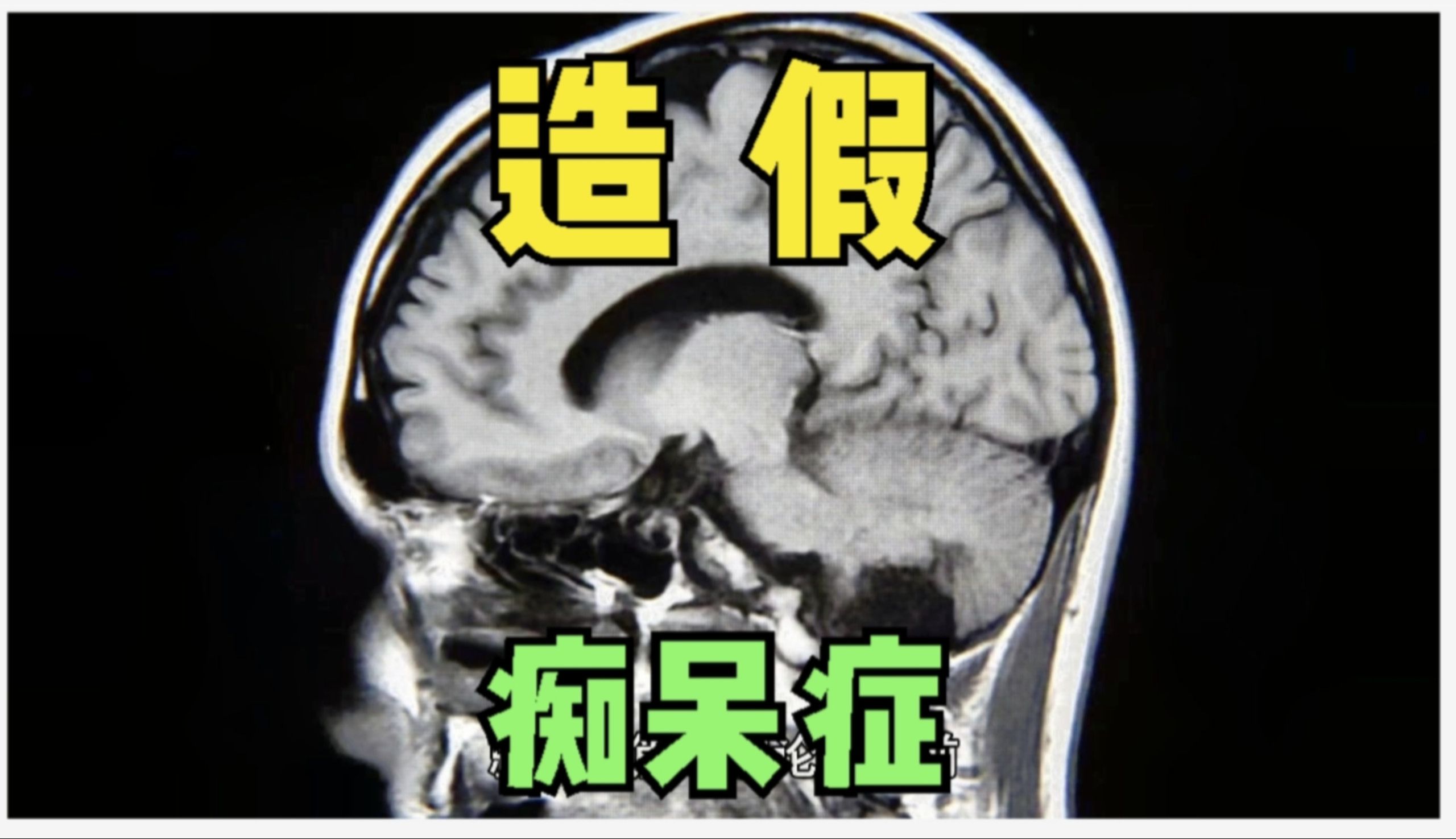 老年痴呆症“开山论文”被指造假,,新药完全作废了么?哔哩哔哩bilibili