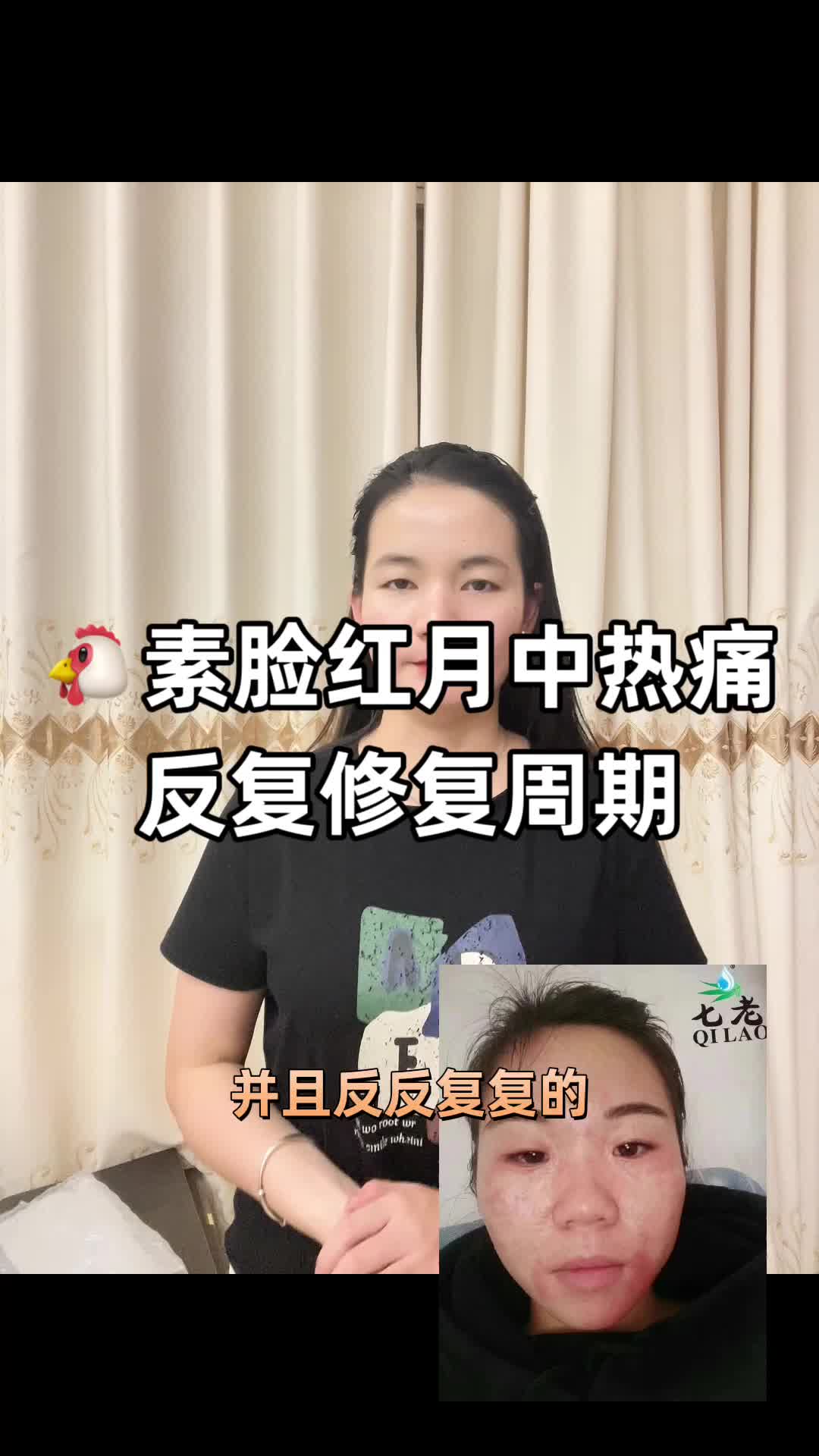 激素脸红肿热痛,反复修复周期