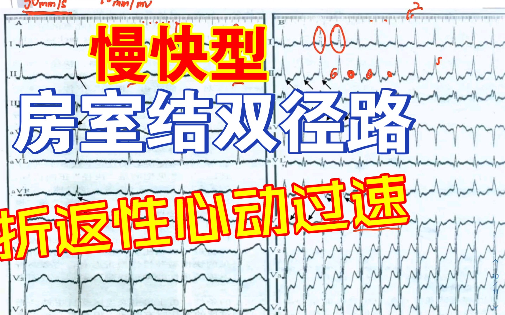 房室结双径路折返性心动过速 慢快型哔哩哔哩bilibili