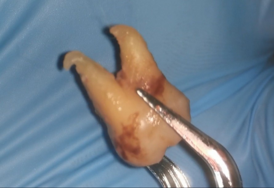 带勾的智齿,如果不是松动,大概率是会断根的