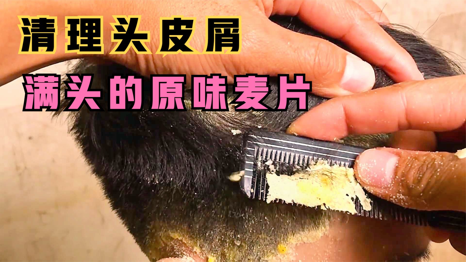 小哥长年不洗头,导致满头都是头皮屑,清洁过程极其舒适!