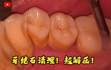 [图]【沉浸式洗牙】超解压的牙结石清理过程（1）！Dokter Gigi Tri Putra