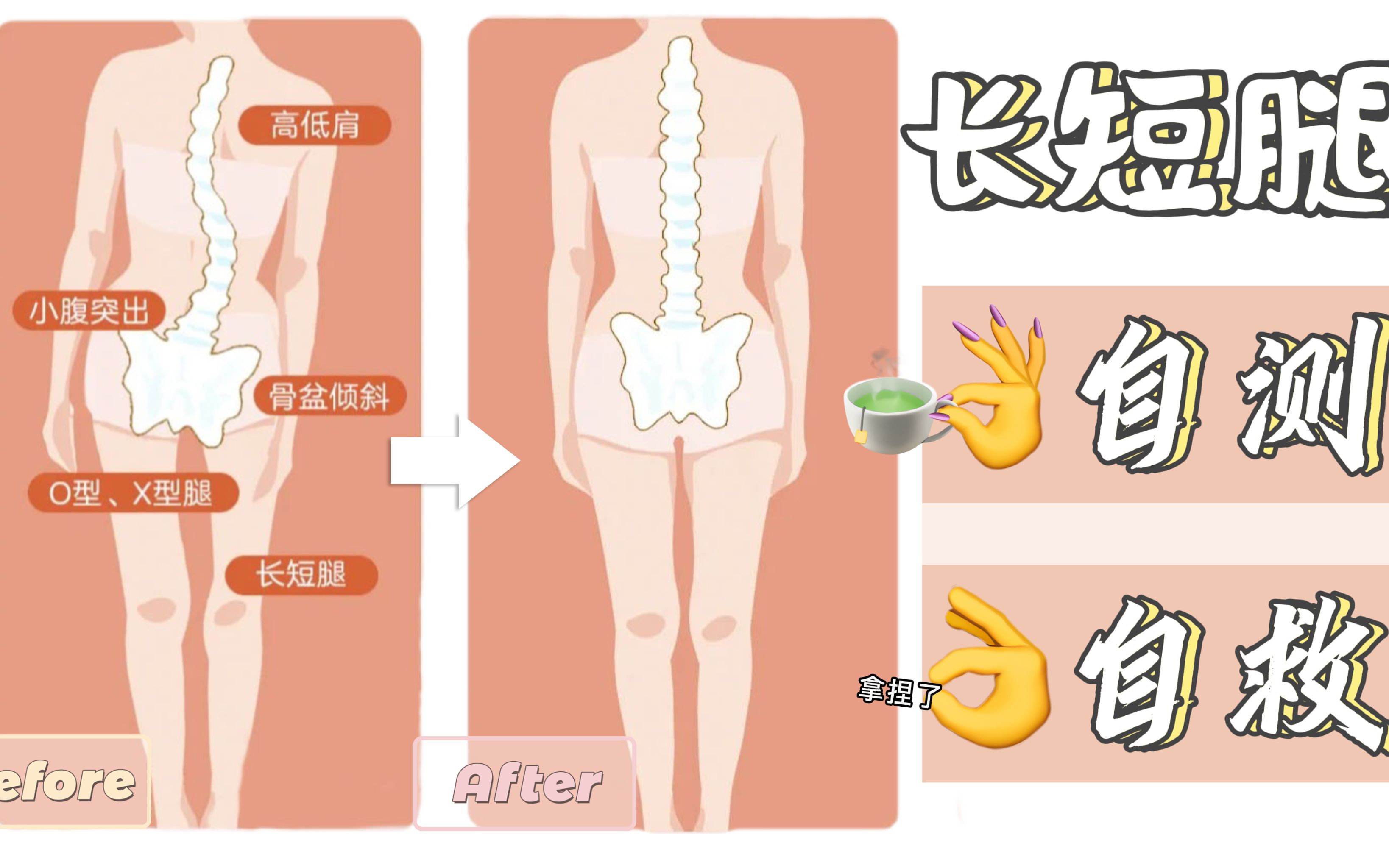 【每日科普】腿不直、长短腿,可不单单是因为高低骨盆的造成哔哩哔哩bilibili