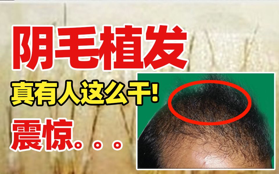 威尼斯植发(植发到底是不是坑人的)