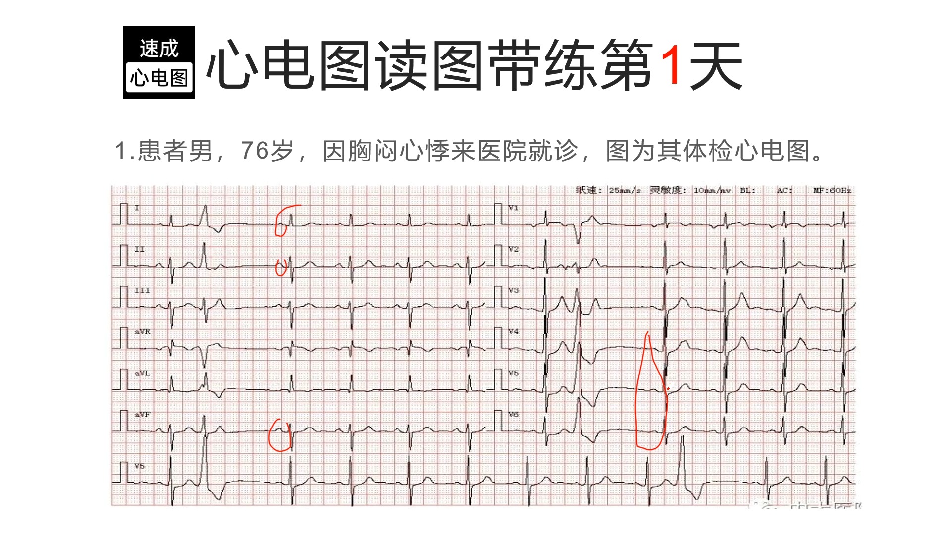 心电图带练哔哩哔哩bilibili