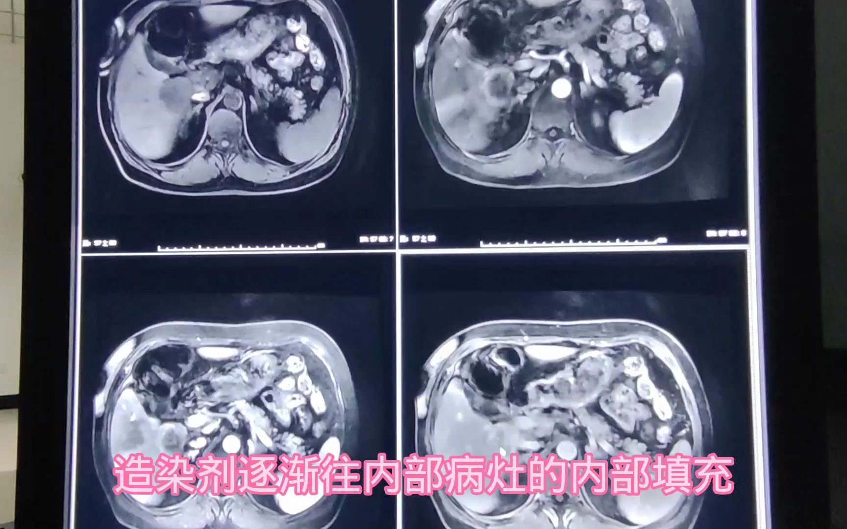 肝内胆管细胞癌(ICC)在磁共振和CT上如何诊断?2分钟学会哔哩哔哩bilibili