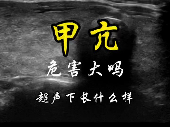 甲亢的危害大吗?超声下长什么样?哔哩哔哩bilibili