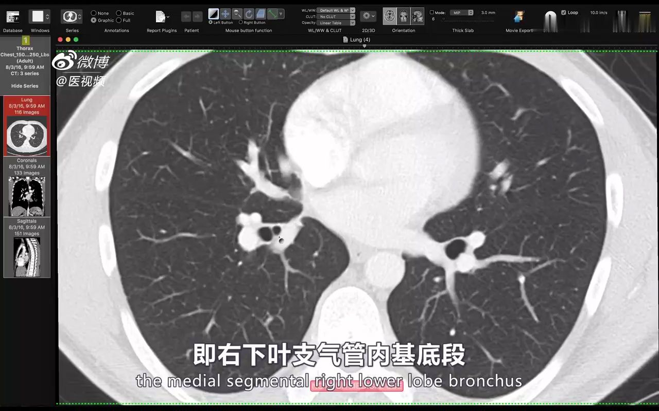 [图][18.1.4] 有关肺叶与肺段