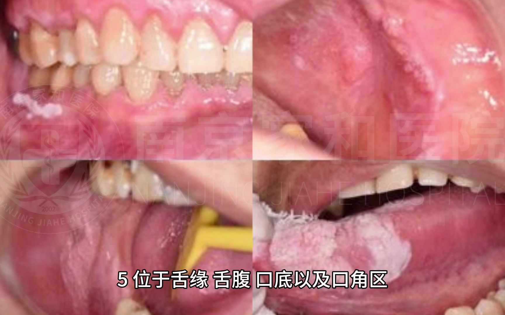 南京家和冯忠兵看口腔白斑好吗