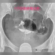 Tải video: 输卵管积水近段堵塞一枚弹簧圈最紧实