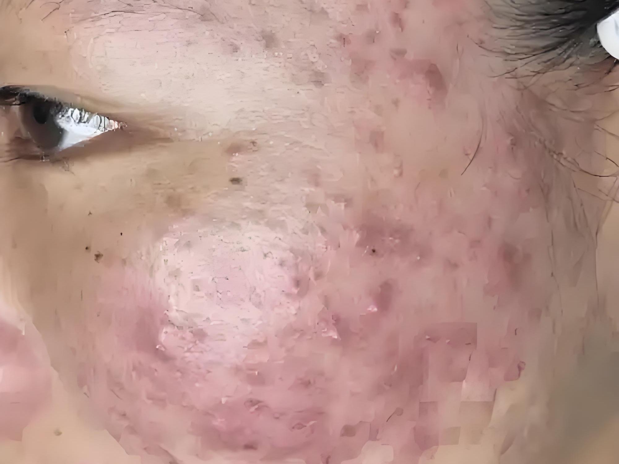 十多年的囊肿痘痘30天在家去除!方法简单一学就会!