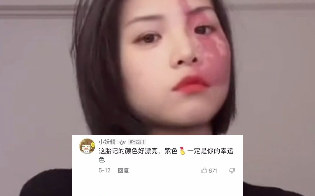 最美胎记女孩,这是被天使吻过的脸吧!哔哩哔哩bilibili